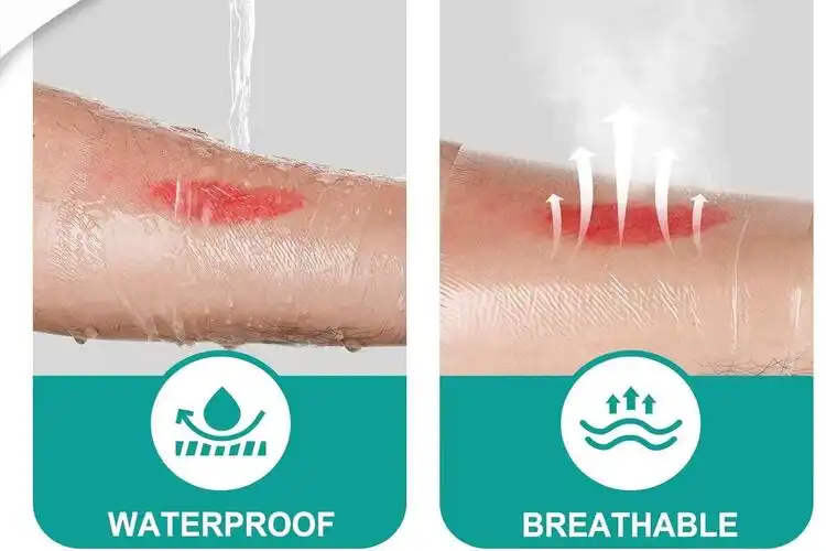 IV Transparent Dressing: Where Comfort Meets Clinical Efficiency